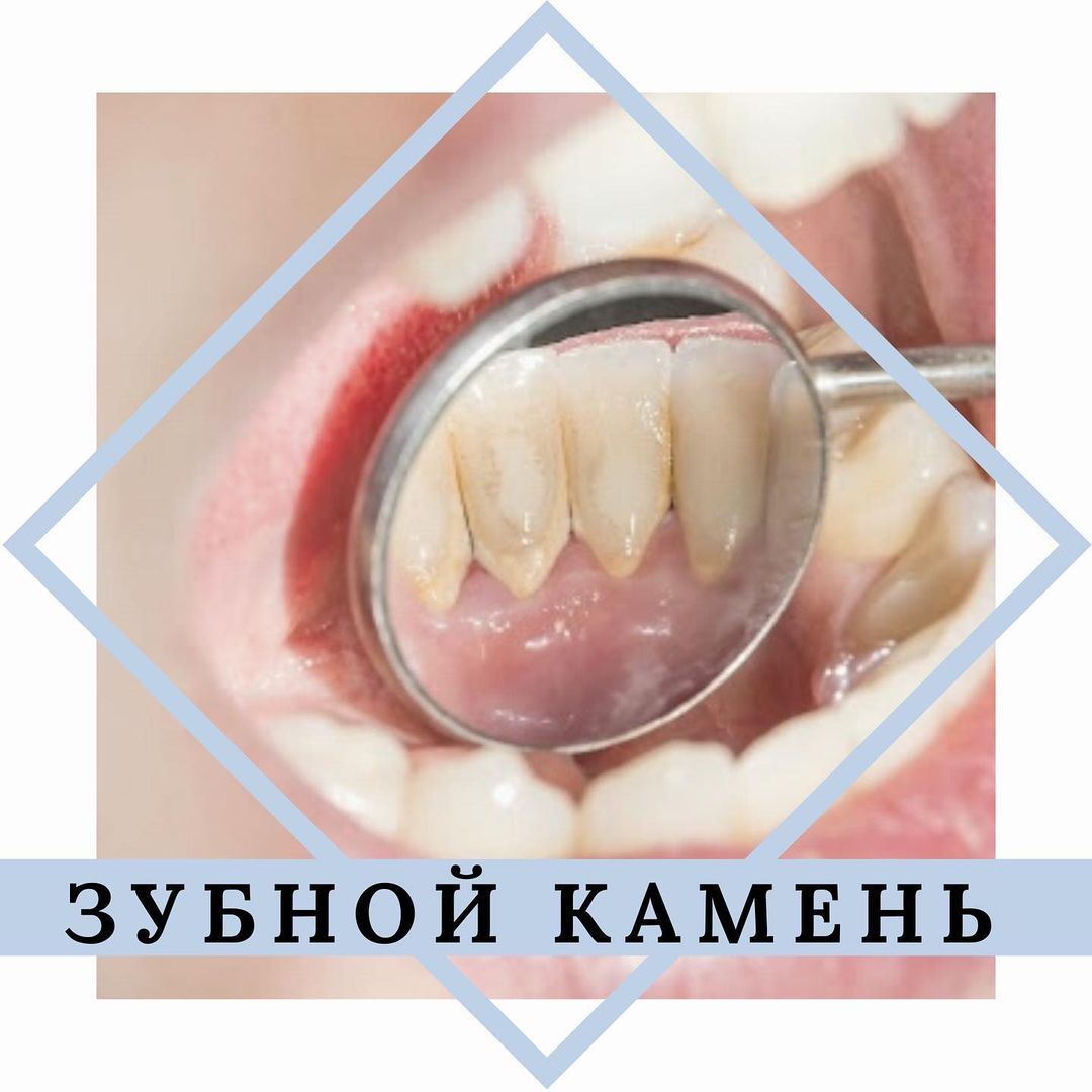 В стоматологическом центре «Стоматолог и Я» проводится процедура профессиональной гигиены Air Flow!