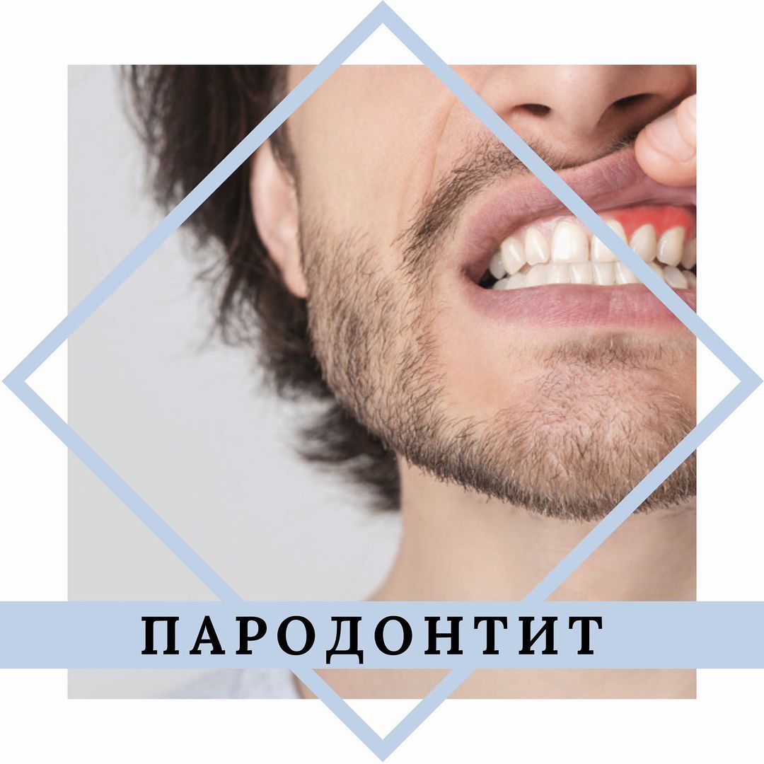Специалисты центра «Стоматолог и Я» рассказывают о профилактике пародонтита