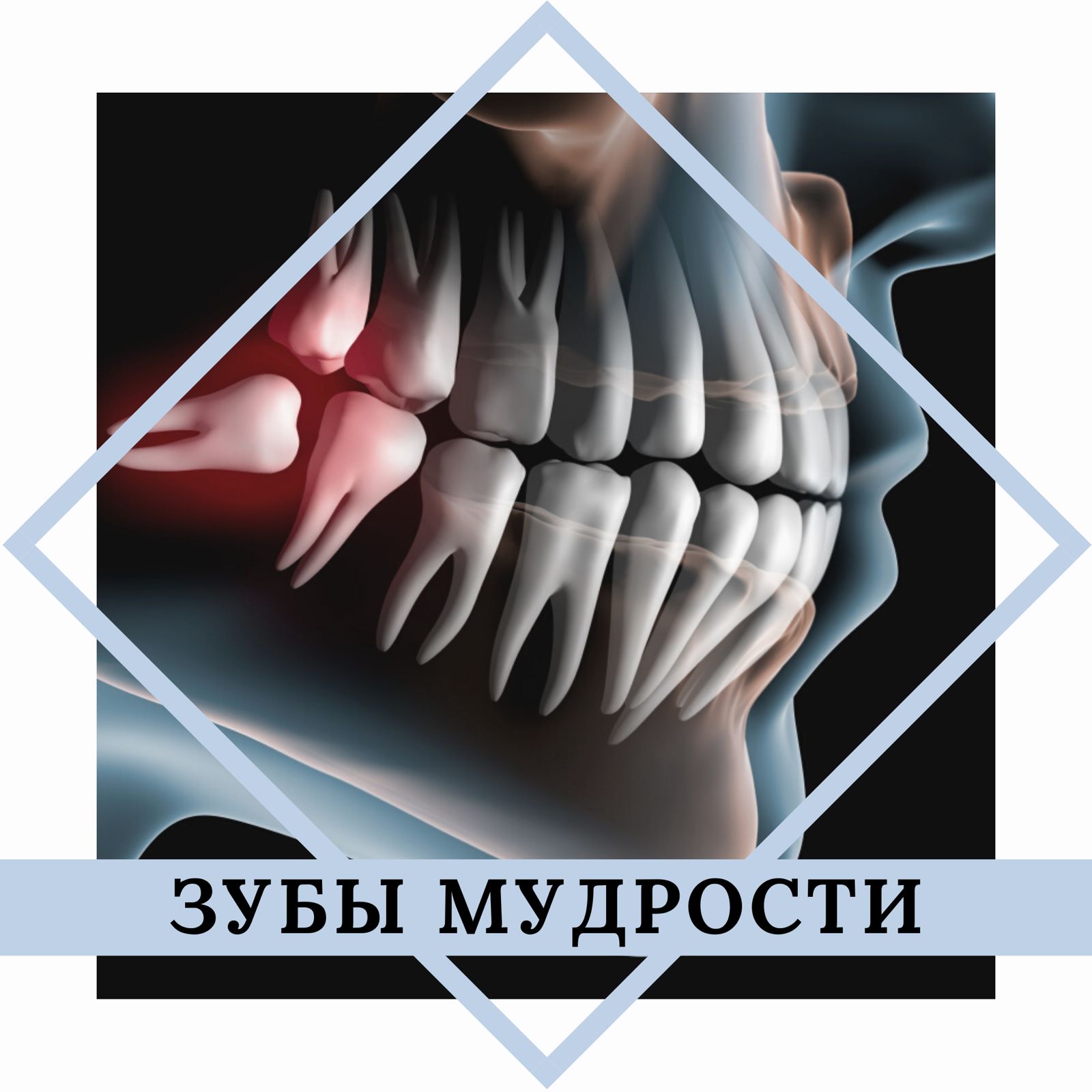 Специалисты медицинского центра «Стоматолог и Я» рассказывают о зубах мудрости